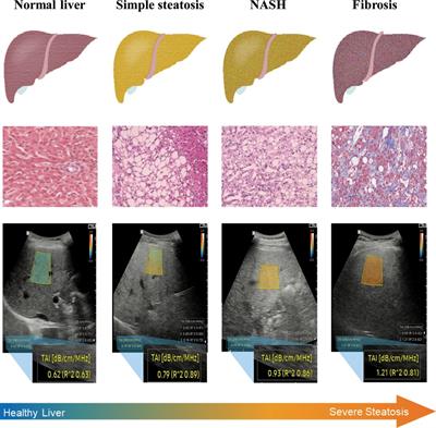 Protocol of quantitative ultrasound techniques for noninvasive assessing of hepatic steatosis after bariatric surgery